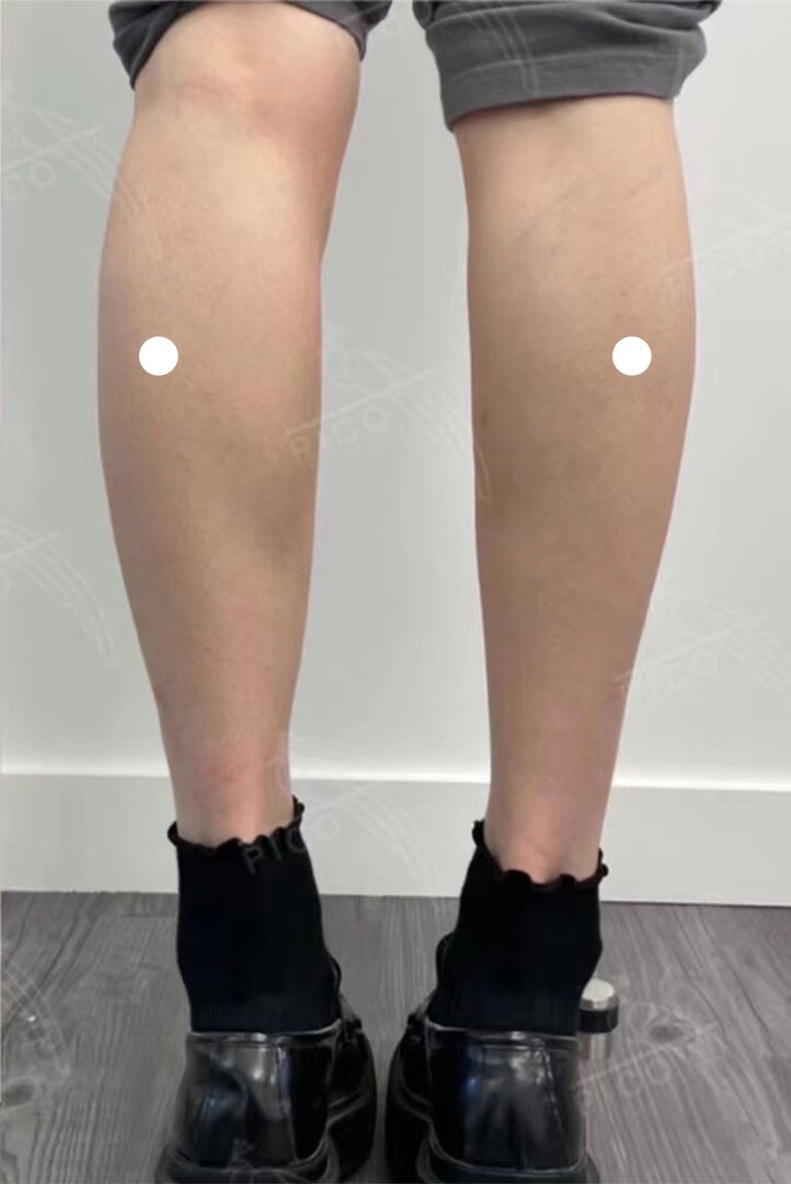 Calf Reduction | Pico Clinics